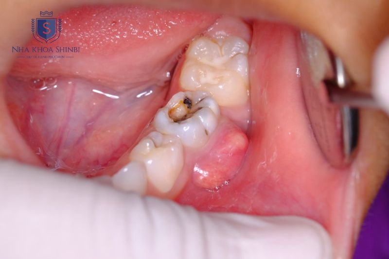 Viêm tủy răng không điều trị có thể gây áp xe và mất răng vĩnh viễn