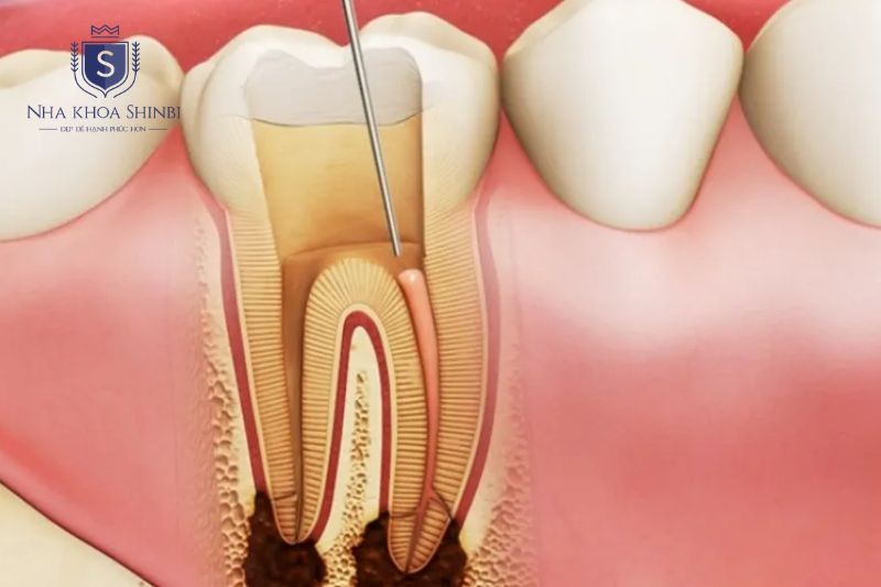 Viêm tủy răng không thể tự khỏi bất kể giai đoạn bệnh
