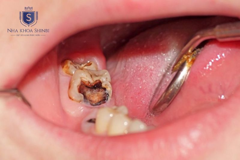 Viêm tủy răng là tình trạng viêm nhiễm bên trong răng không thể tự hồi phục