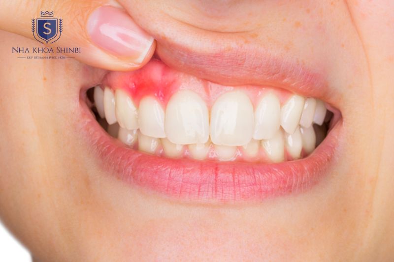 Yếu tố toàn thân như thiếu vitamin nội tiết bệnh lý làm nướu dễ chảy máu