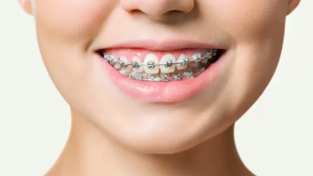 Orthodontic Treatment. Dental Care Concept. Beautiful Woman Healthy Smile close up. Closeup Ceramic and Metal Brackets on Teeth. Beautiful Female Smile with Braces; Shutterstock ID 1892379781; purchase_order: -; job: -; client: -; other: -
