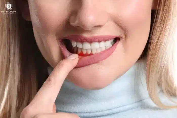 bọc răng sứ bị viêm lợi 