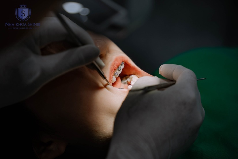 Bước chuẩn bị quan trọng trước khi nhổ răng khôn