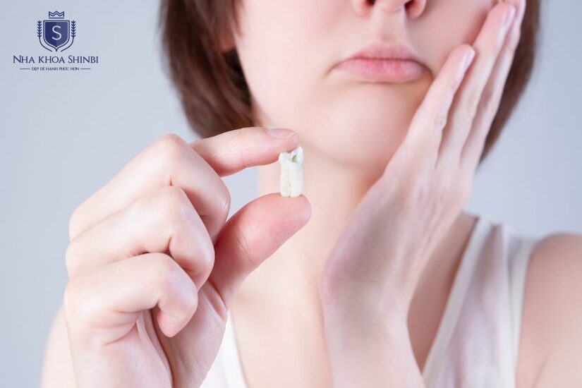 Giá nhổ răng khôn phụ thuộc vào tình trạng cụ thể