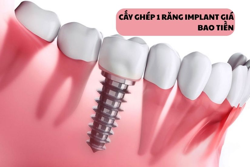 Cấy ghép 1 răng Implant giá bao nhiêu tiền? Cấy ghép 1 răng Implant giá bao nhiêu tiền?