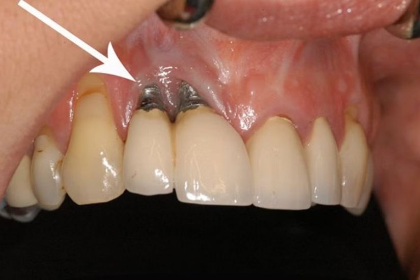 cay-ghep-implant-gia-re-lieu-co-tot-khong cay-ghep-implant-gia-re-lieu-co-tot-khong