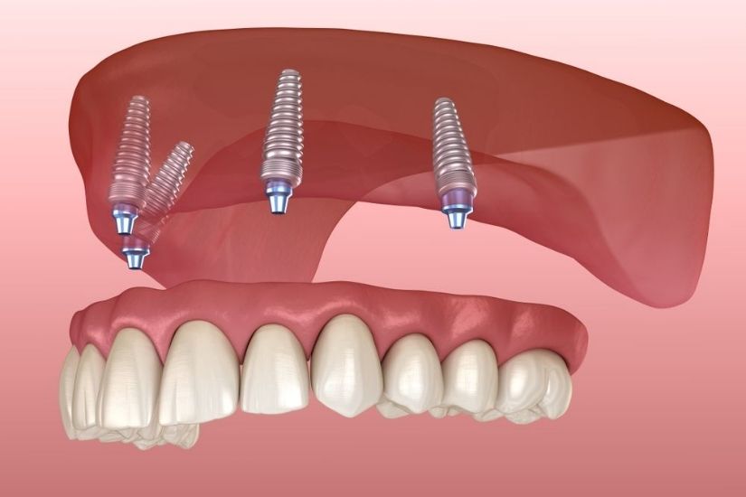 Giá cấy ghép Implant toàn hàm Giá cấy ghép Implant toàn hàm