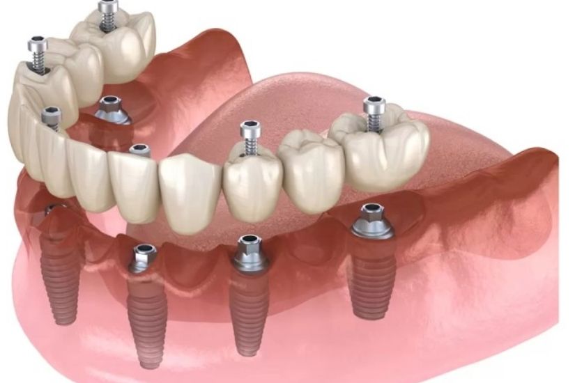 so-luong-tru-implant-rang-su-su-dung so-luong-tru-implant-rang-su-su-dung