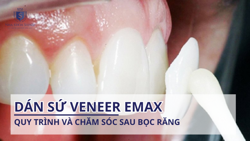 Dán sứ Veneer Emax: Quy trình và chăm sóc sau bọc răng