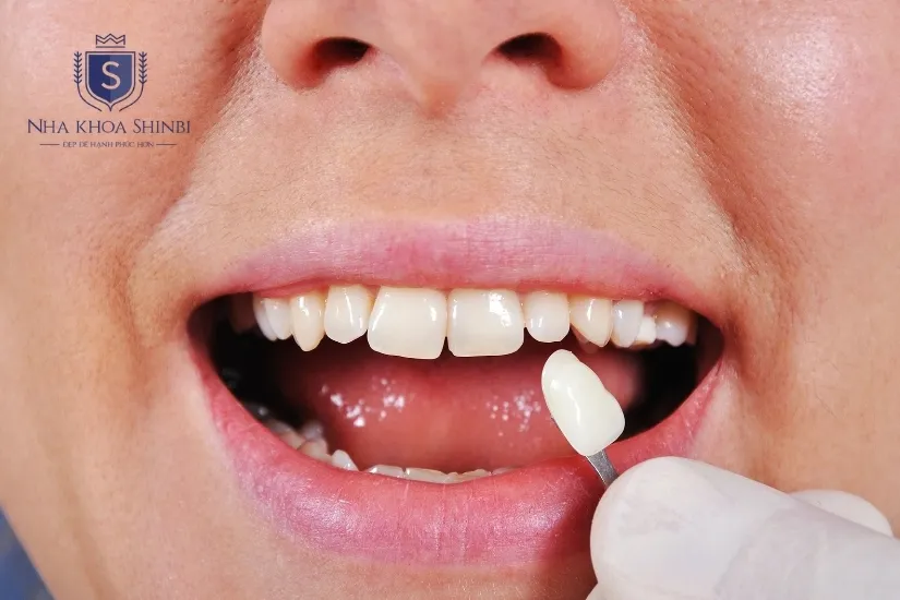 Miếng dán răng sứ Veneer là gì? Miếng dán răng sứ Veneer là gì?