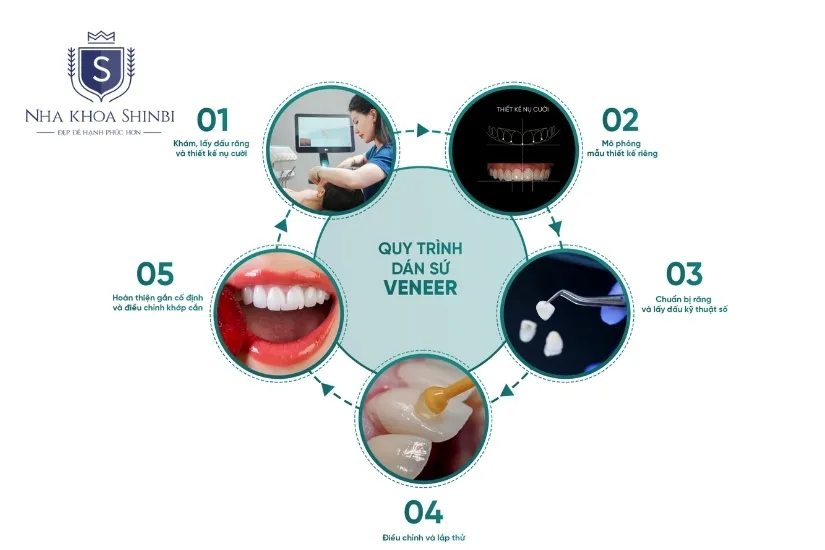 Quy trình dán răng sứ Veneer tại nha khoa Shinbi Quy trình dán răng sứ Veneer tại nha khoa Shinbi