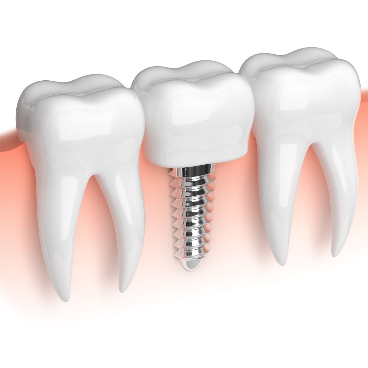 Trụ Implant Izen (Hàn Quốc)