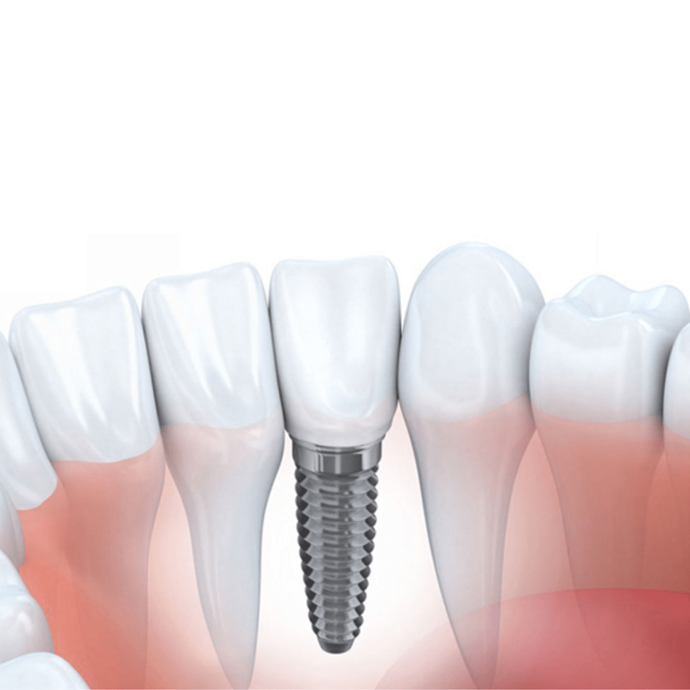 Trụ Implant Biotem Hàn Quốc