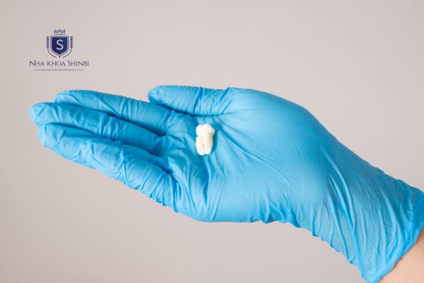 Giữ lại phần răng sứ đã rơi ra Giữ lại phần răng sứ đã rơi ra