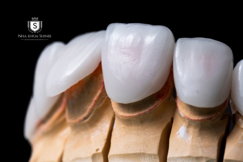 Răng sứ kim loại thời hạn sử dụng 5 - 7 năm