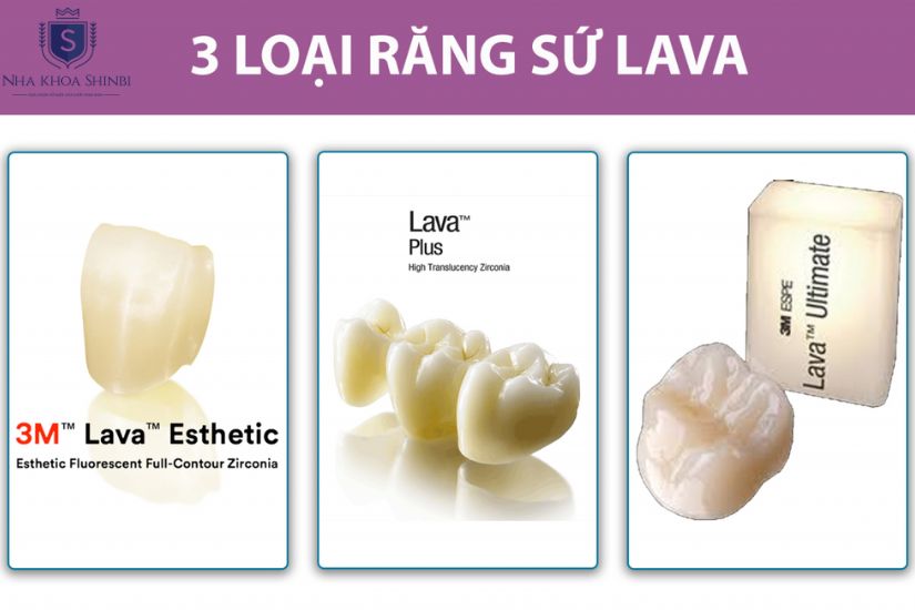 Bọc răng sứ Lava loại nào tốt nhất