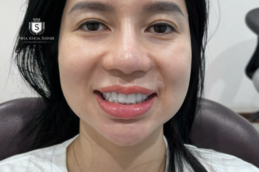 Răng sứ Zirconia có khả năng chịu được tốt