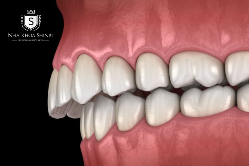 Nắm rõ tình trạng răng miệng và biện pháp điều trị phù hợp Nắm rõ tình trạng răng miệng và biện pháp điều trị phù hợp