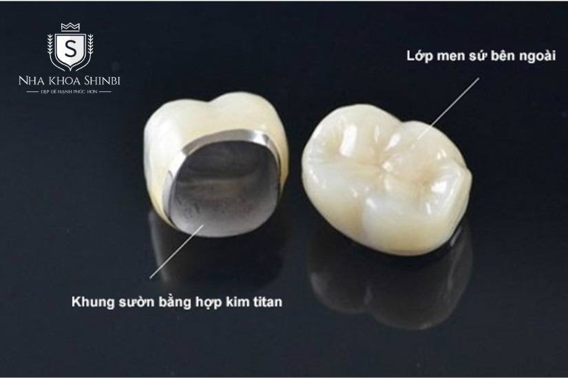 Răng sứ Titan có độ bền cao, giá thành phải chăng Răng sứ Titan có độ bền cao, giá thành phải chăng