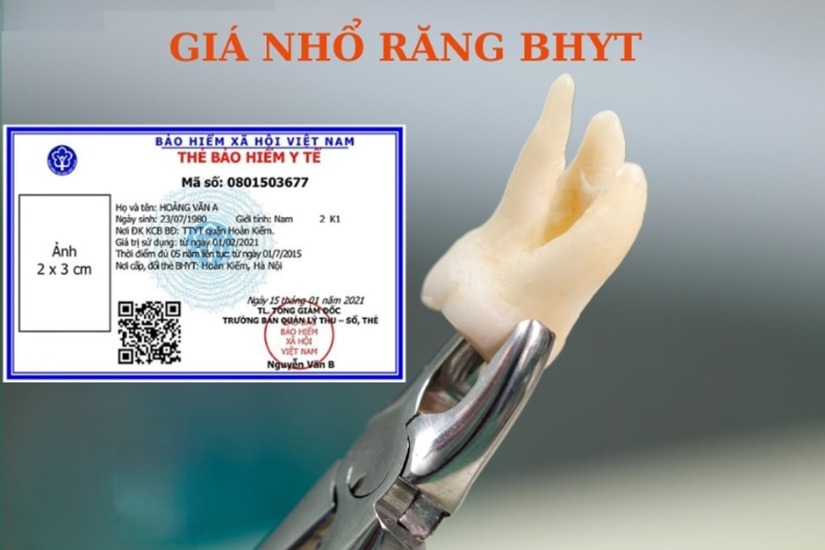 Mức hưởng bảo hiểm nhổ răng không là bao nhiêu? Mức hưởng bảo hiểm nhổ răng không là bao nhiêu?