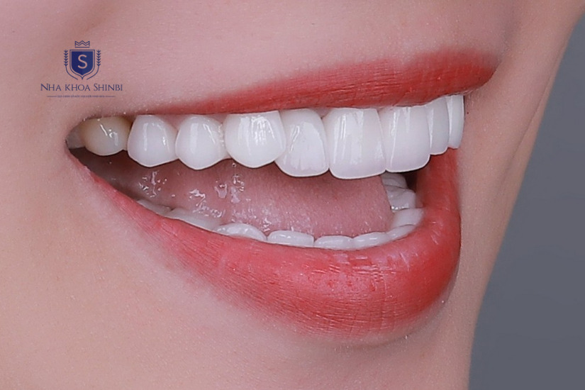 Răng lung lay nhẹ cần can thiệp điều trị trước khi bọc sứ Răng lung lay nhẹ cần can thiệp điều trị trước khi bọc sứ