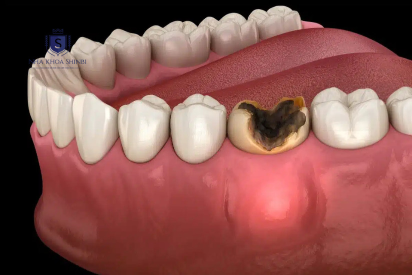 Răng bị sâu nghiêm trọng không nên bọc sứ Răng bị sâu nghiêm trọng không nên bọc sứ