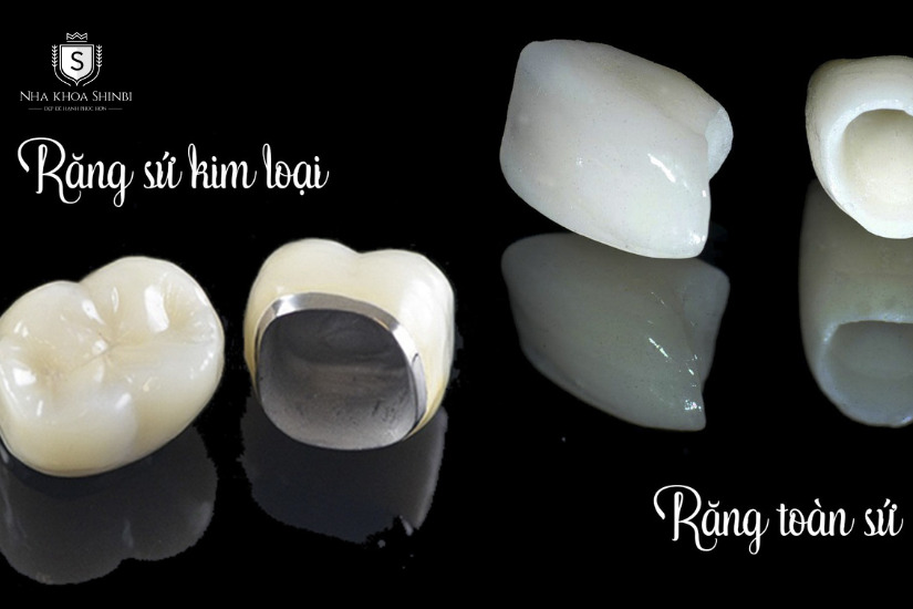 Răng sứ kim loại và răng toàn sứ Răng sứ kim loại và răng toàn sứ