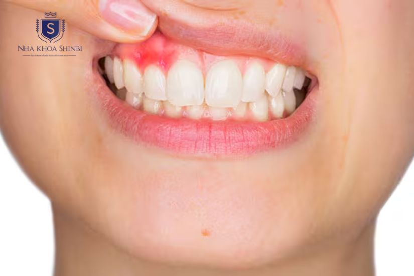 Sau khi cấy ghép implant, việc bị sưng và đau là điều hết sức bình thường Sau khi cấy ghép implant, việc bị sưng và đau là điều hết sức bình thường