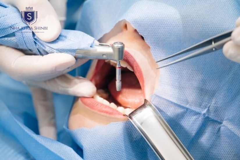 Trồng răng Implant an toàn, chất lượng tại Nha khoa Shinbi Trồng răng Implant an toàn, chất lượng tại Nha khoa Shinbi