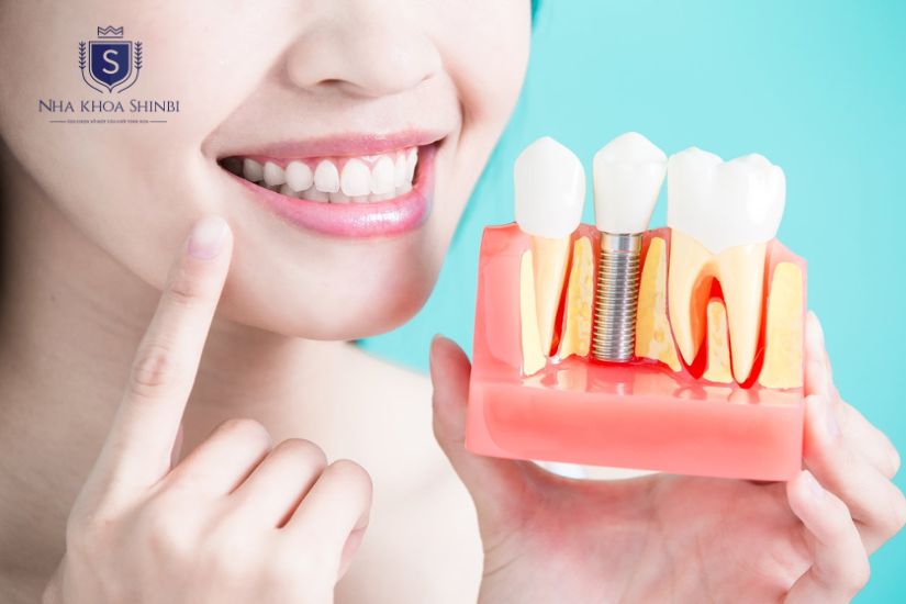 Trồng răng Implant an toàn khi chọn bác sĩ giỏi, trụ chất lượng và đảm bảo sức khỏe tốt. Trồng răng Implant an toàn khi chọn bác sĩ giỏi, trụ chất lượng và đảm bảo sức khỏe tốt.