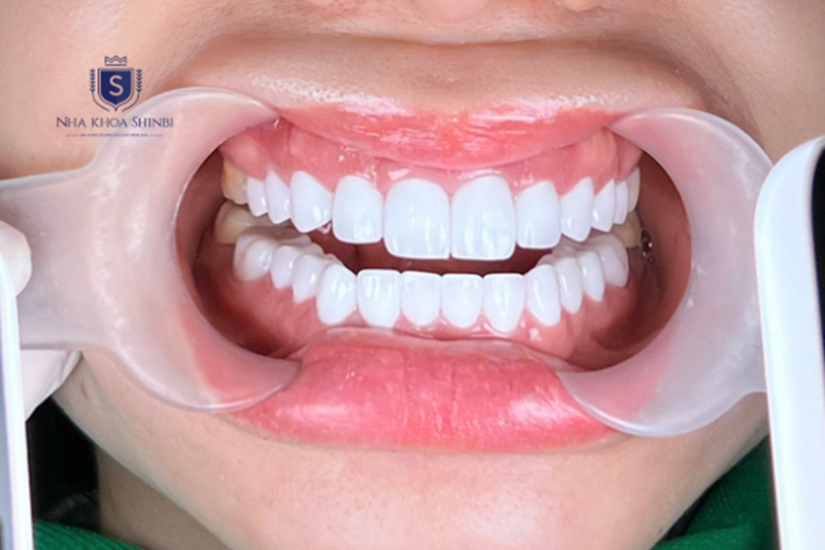 Bọc răng sứ Zirconia đem lại tính thẩm mỹ cao