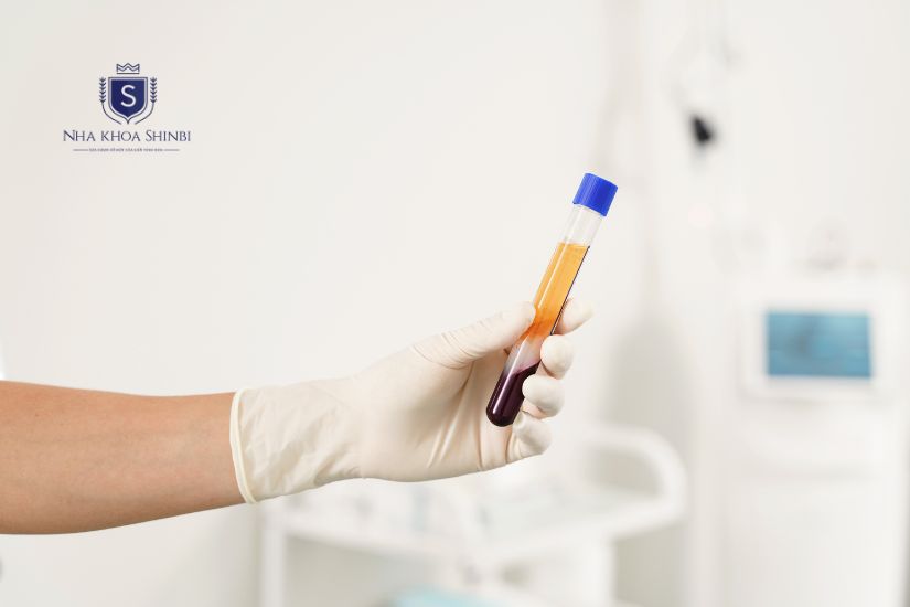 Mẫu máu của bệnh nhân khi quay li tâm để tạo Fibrin giàu tiểu cầu Mẫu máu của bệnh nhân khi quay li tâm để tạo Fibrin giàu tiểu cầu