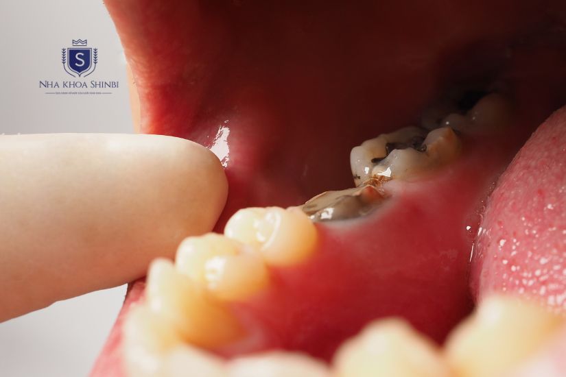 Răng cấm bị sâu Răng cấm bị sâu