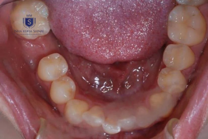 Răng cấm sau khi cắt chỉ Răng cấm sau khi cắt chỉ