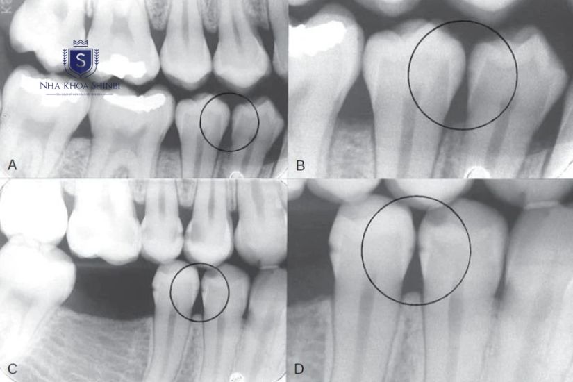 Răng sau dưới màn hình X-Quang Răng sau dưới màn hình X-Quang