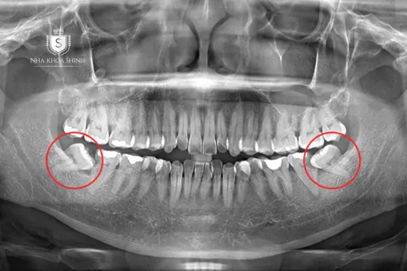 Răng số 7 mọc lệch khi chụp X-quang răng Răng số 7 mọc lệch khi chụp X-quang răng