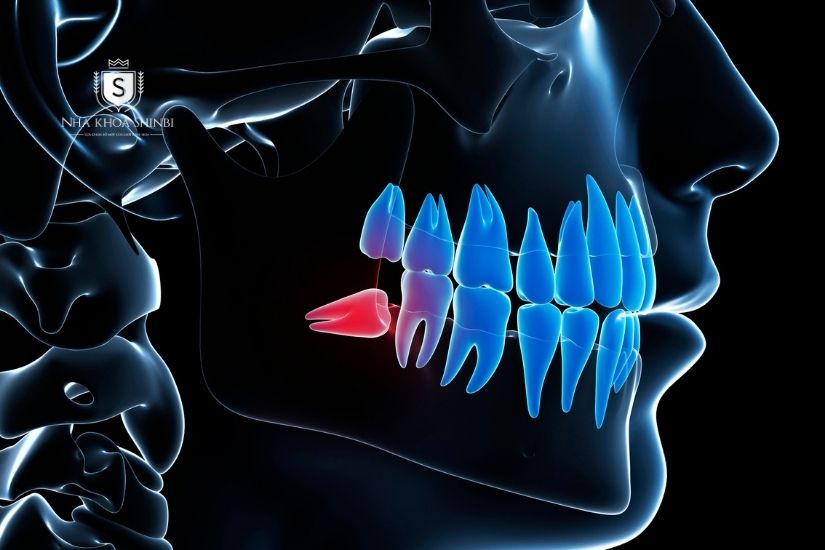 Răng khôn mọc lệch 90 độ