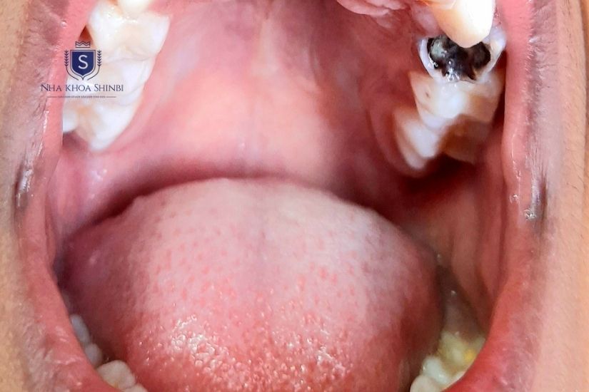 Răng số 6 hàm trên bị sâu nặng Răng số 6 hàm trên bị sâu nặng