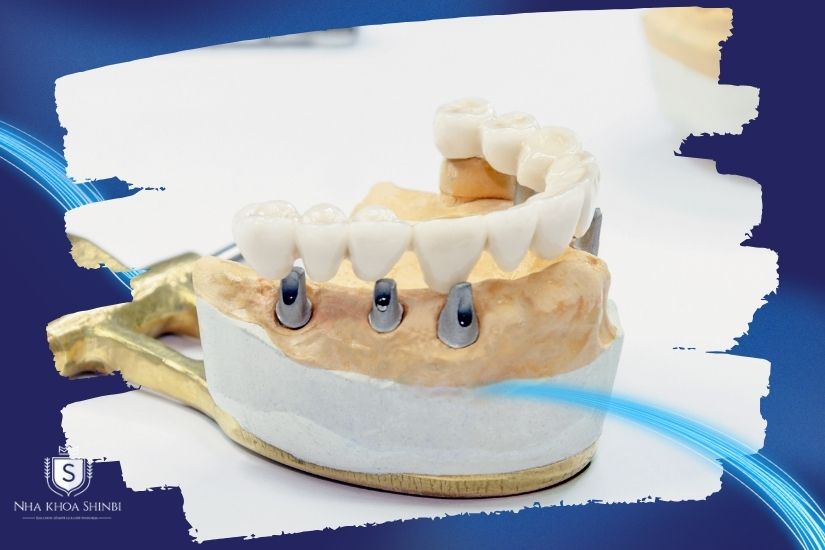 Loại vật liệu răng sứ sử dụng Loại vật liệu răng sứ sử dụng