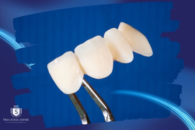 Chi phí bọc răng sứ 2 cái Chi phí bọc răng sứ 2 cái