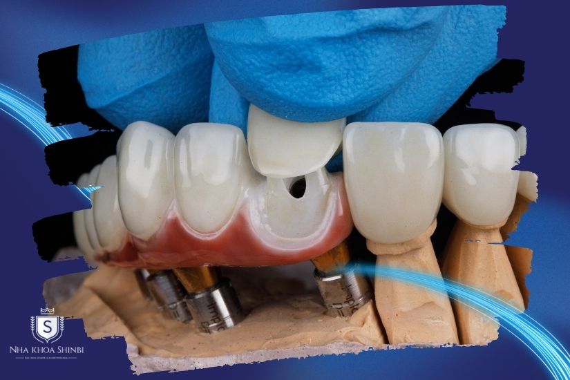 Tình trạng răng ban đầu ảnh hưởng đến chi phí Tình trạng răng ban đầu ảnh hưởng đến chi phí