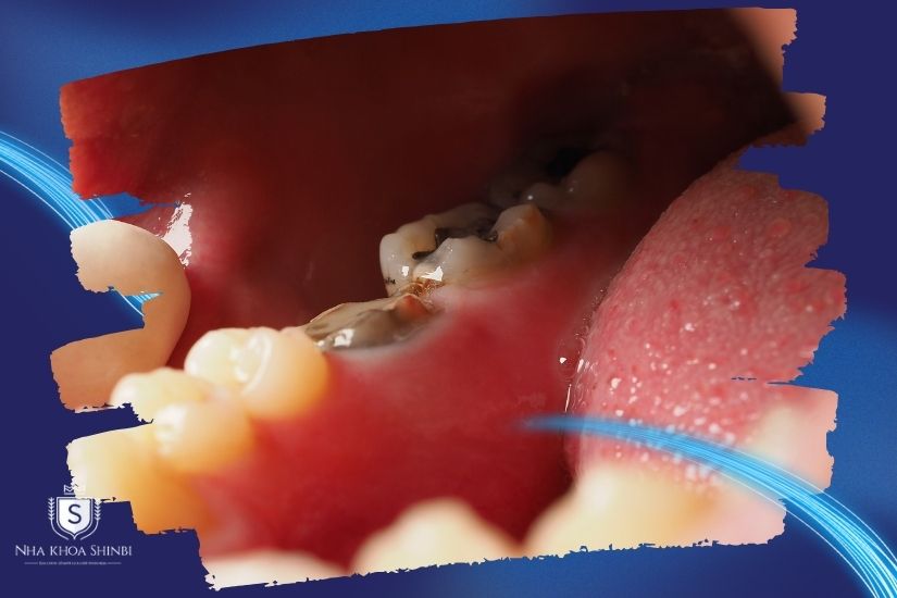 Người có răng hàm bị sâu Người có răng hàm bị sâu