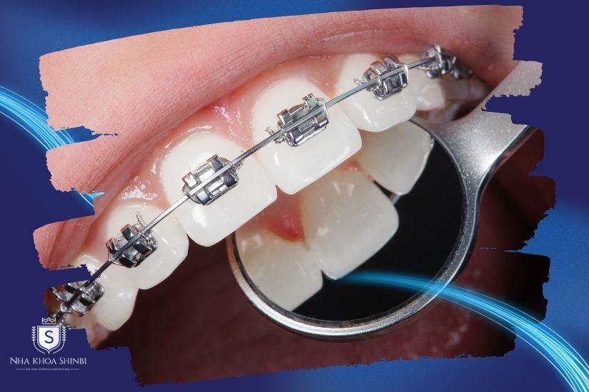 Niềng răng có thẩm mỹ răng sứ được không? Niềng răng có thẩm mỹ răng sứ được không?