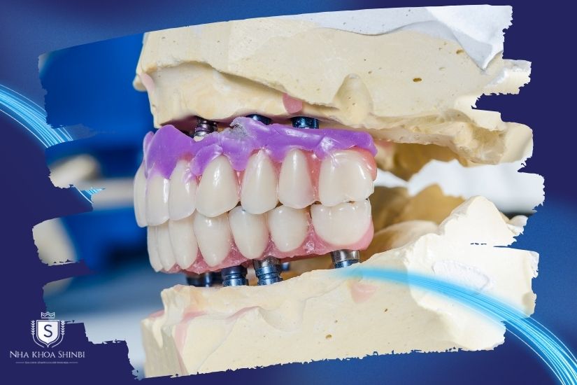 Chất liệu răng sứ chính hãng Chất liệu răng sứ chính hãng