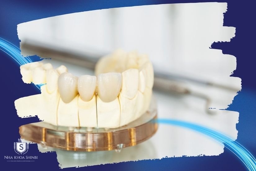 Khám phá bọc răng sứ trong bao lâu Khám phá bọc răng sứ trong bao lâu