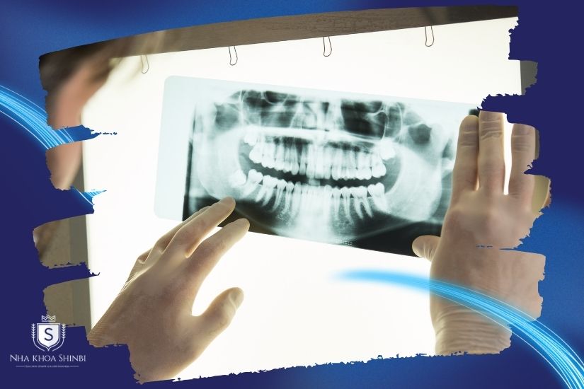 Chụp phim và lấy dấu răng Chụp phim và lấy dấu răng