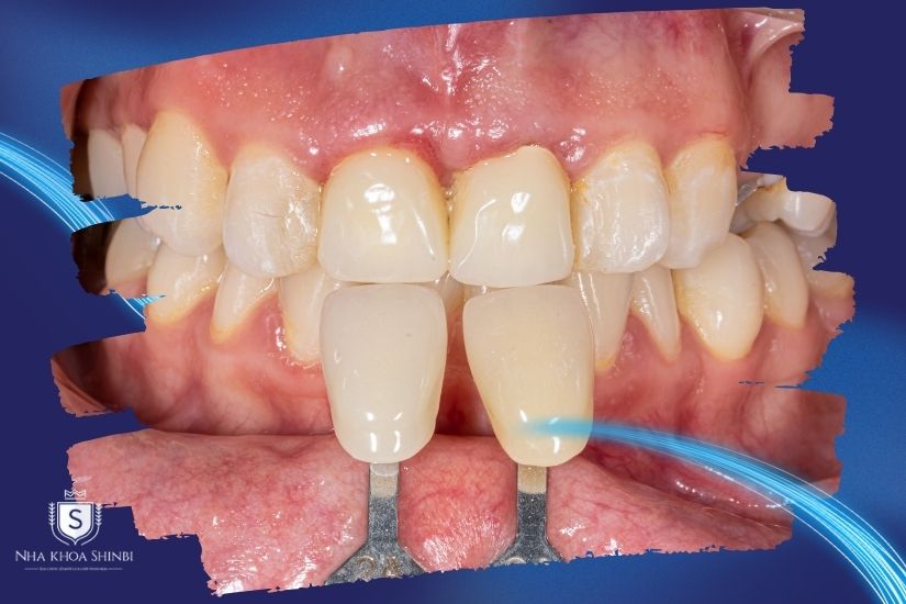 Lắp răng sứ cố định Lắp răng sứ cố định