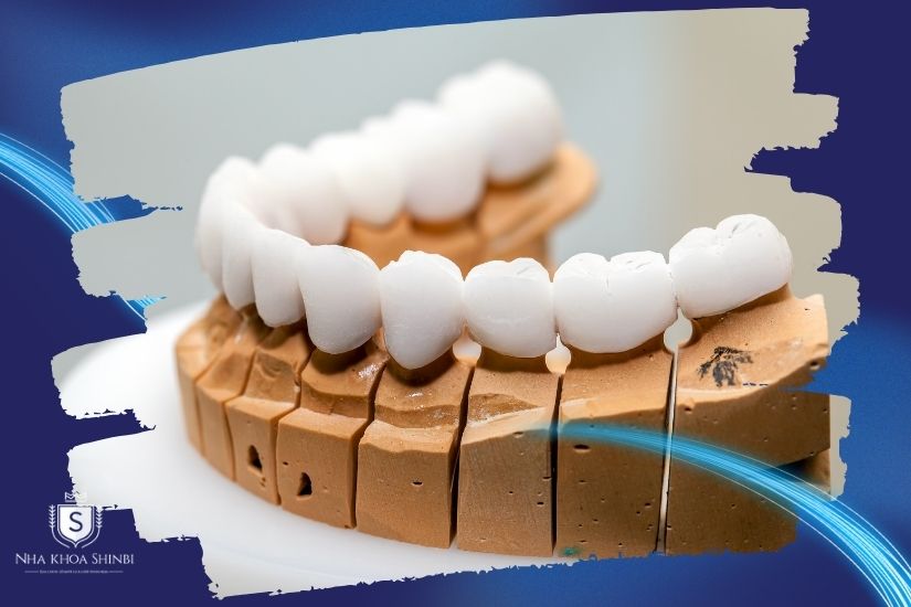 Loại răng sứ lựa chọn Loại răng sứ lựa chọn