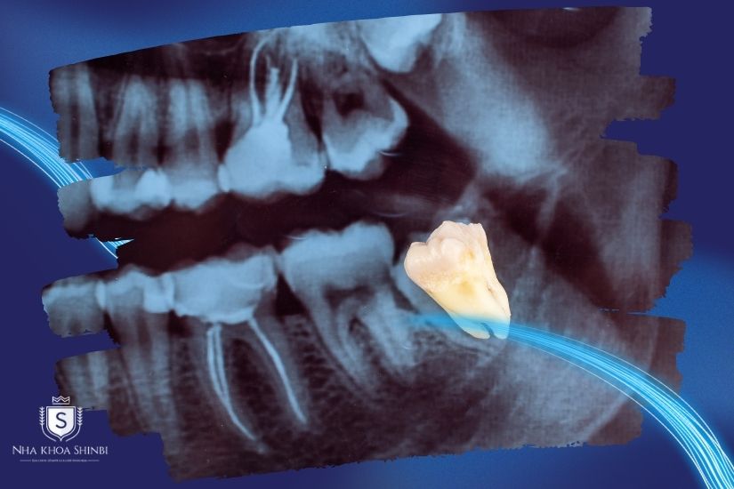 Nhổ răng khôn bằng máy siêu âm Piezotome