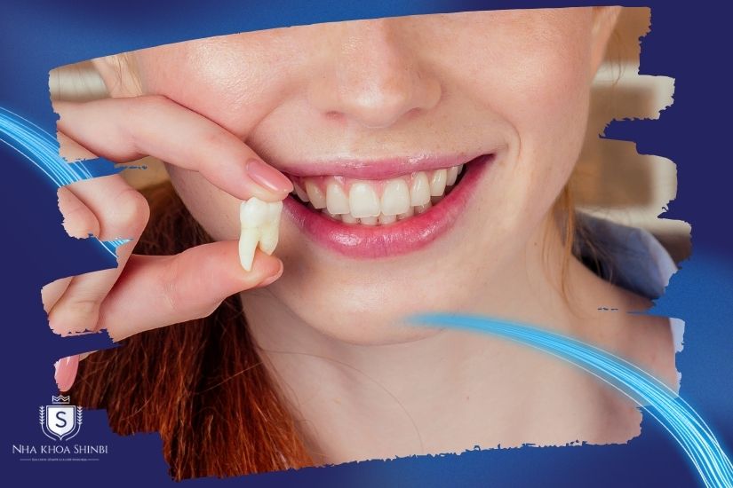 Các phương pháp nhổ răng khôn tùy thuộc vào tình trạng răng